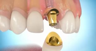 Какой смысл делать имплантацию зубов?