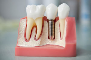 Имплантацию зубов