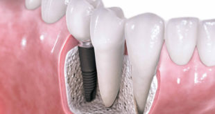 chto nuzhno znat o zubnyh implantatah