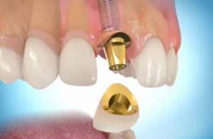Какой смысл делать имплантацию зубов?