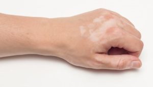 Lechenie vitiligo