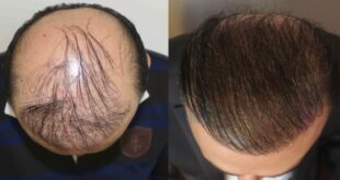 Пересадка волос методом FUE